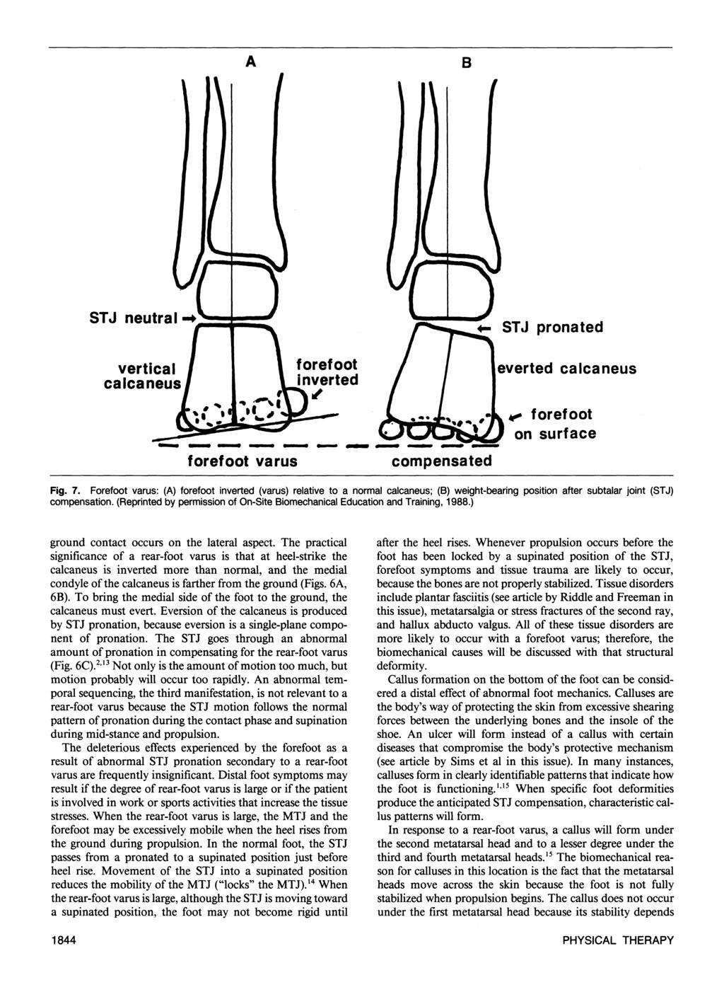Fig. 7. Forefoot varus: (A) forefoot inverted (varus) relative to a normal calcaneus; (B) weight-bearing position after subtalar joint (STJ) compensation.