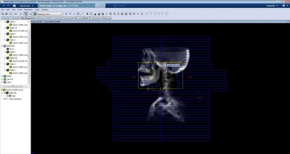 (2) Isocentric 3D CRT Plans Verification was performed for sites namely brain, head & neck, esophagus, abdomen, pelvis, prostate and rectum as shown in table 2.