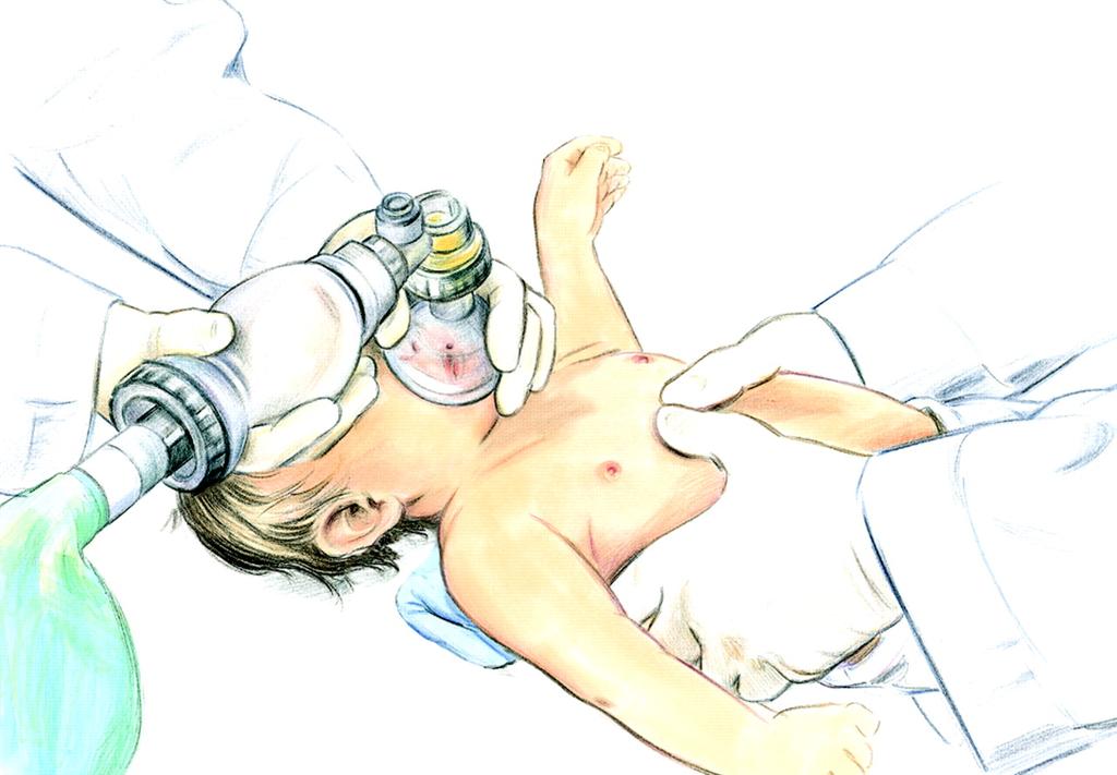 Two thumb-encircling hands chest compression in infant (2 rescuers). Berg M et al.