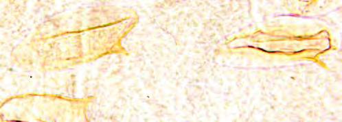 revealing eggs of Schistosoma