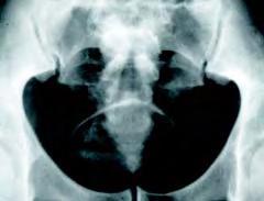 Calcification of dome of bladder due