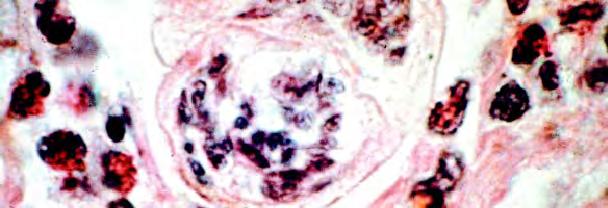 Cercaria of Schistosoma mansoni in skin surrounded by eosinophils