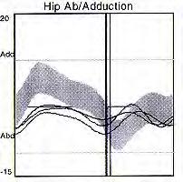 Excessive adduction Trendelenburg gait = weak Glut Medius (2.5x BW), spastic hip adductors, substitution of adductors for weak hip flexor, hip pain (joint force = 3.