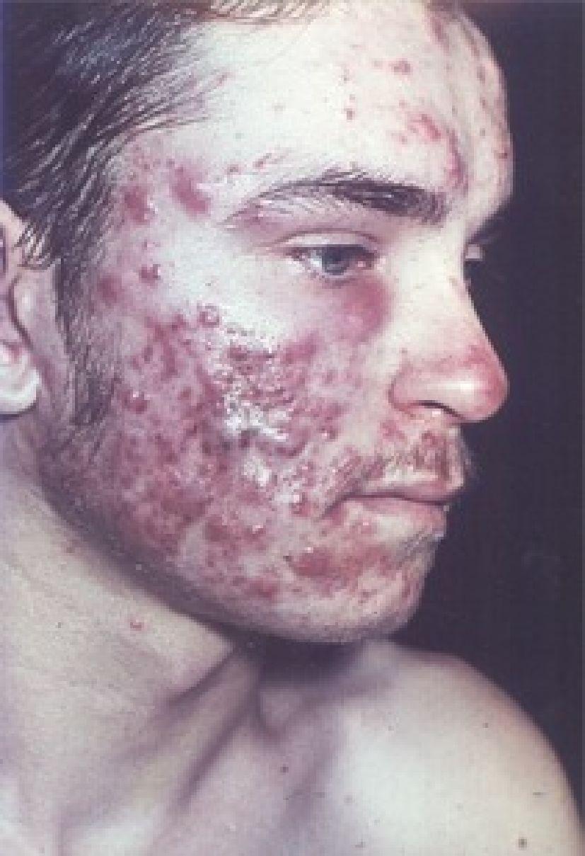Side Effects of Andro (Males) Acne Diminished sperm production