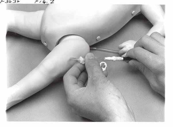 B A 7. Close the clamp on IV bag A and open the pinch clamp on the leg tubing at the basin. Figure 8 G. Preparing the Leg for Intravenous Infusions: 1.