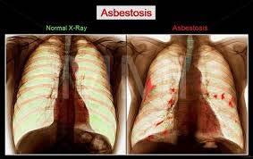 Health Effects of Asbestos Non