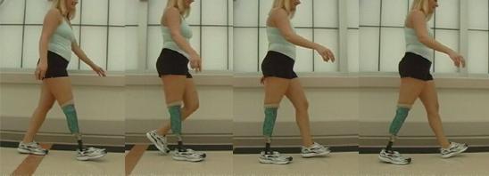 Amputee gait 1. Above the knee (AK) 2.