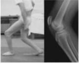 Crouch gait Consider degrees of severity Knee flexion > 30 deg, ankle dorsiflexion > 2SD, Reduced hip extension Increased