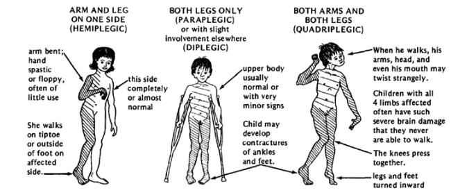 Diplegic gait - Spasticity of both limbs.