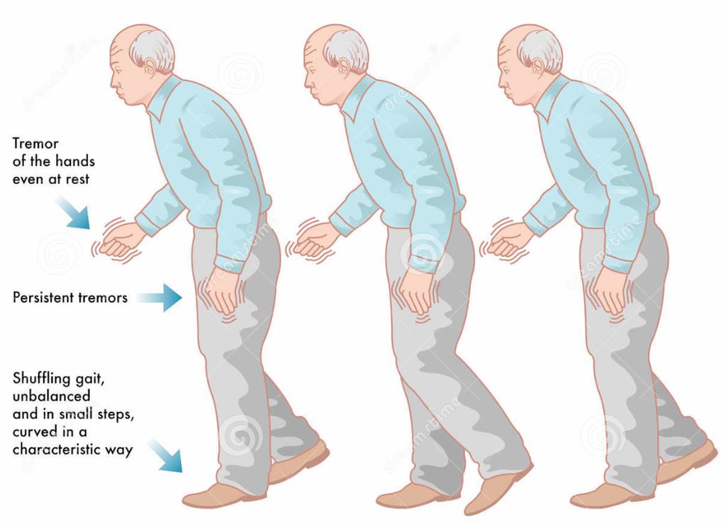 Parkinsonian gait - 3 classical signais: resting tremor, rigidity, and bradykinesia.