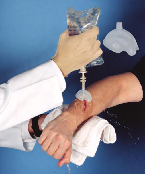 away from cleansed area and toward the outlet ports Working together, a saline bag uses a Combiport attached to a Combiguard II to effectively cleanse the wound