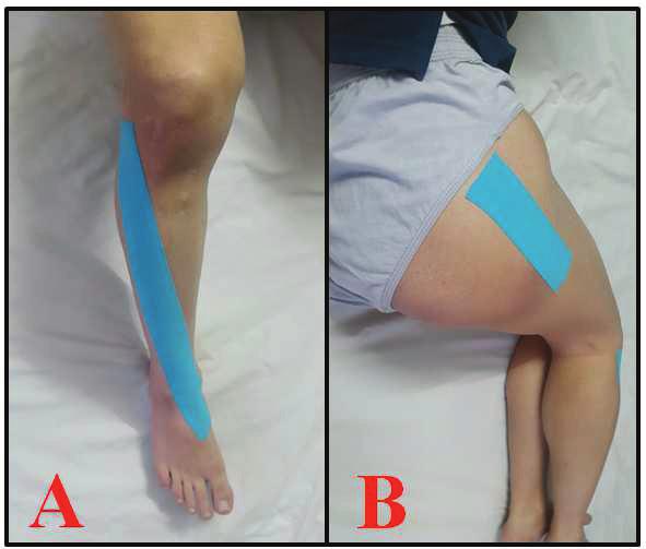 Figure 1. Kinesio taping of (A) tibialis anterior and (B) gluteus medius muscles. First, participants were allowed to perform up to five landing trials to become familiar with landing task.