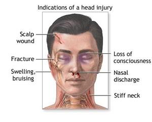 Head Injury Depending on the severity, a head injury may be evidenced by a visible wound, swelling, nasal discharge, or even loss of consciousness.