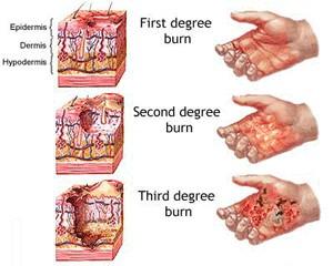 Burns Burns may be classified according to extent and depth of damage as follows: First degree - Minor The burned area is painful. The outer skin is reddened. Slight swelling is present.