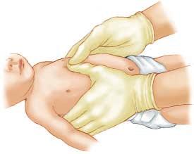 Compress the sternum approximately one third to one half the depth of the infant s chest. With two fingers, perform compressions at a rate of at least 100/min Figure A-29B.