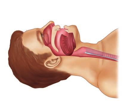 A-10 Appendix A BLS Review A Tongue blocking air passage B Air passage opened Tongue forward Air passage Figure A-8 A. Relaxation of the tongue back into the throat causes airway obstruction. B. The head tilt chin lift maneuver combines two movements of opening the airway.