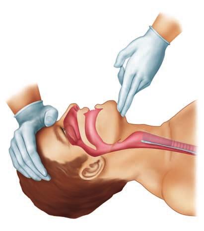 Lift the chin forward, bringing the entire lower jaw with it, helping to tilt the head back. tilt the patient s head back.