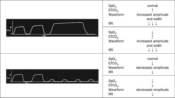 Hypoventilation (hypopnoeic) Note the top waveform is bradypnoeic hypoventilation whereas the