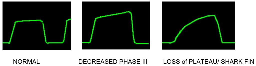 the phase III as well. Depending on the severity of airway obstruction, phase II can also be prolonged.