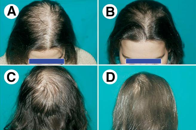 Hair loss in women 29 Treatment of Excess Release of Ovarian Androgens (Ovarian SAHA) and FPHL in Ovarian Hyperandrogenism and FPHL in Normoandrogenic Postmenopausal Women Three types of treatment