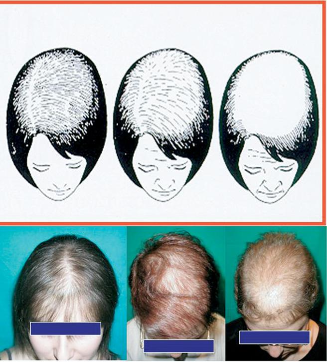 This makes it more difficult, although still possible, to camouflage the alopecia with combing the hair forward. This pattern of alopecia is a marker of excess androgens, generally of ovarian origin.
