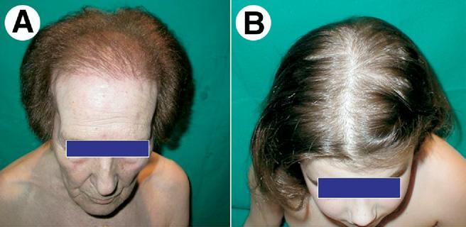 Hair loss in women 21 Figure 3 Ebling s classification: 5 progressive stages of hair loss. The final example is Hippocratic alopecia as in men. Reprinted with permission from Ludwig et al. 29 FAGA.M.