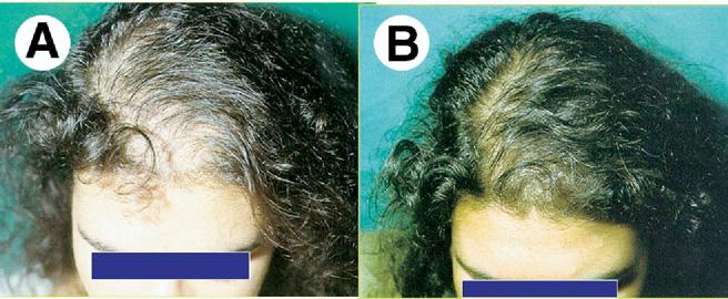 Hair loss in women 27 Figure 8 FPHL in adrenal SAHA treated for 2 years with minoxidil, 3% twice a day, 100 mg for 6 months of cyproterone acetate from the fifth to the 15th days of the menstrual