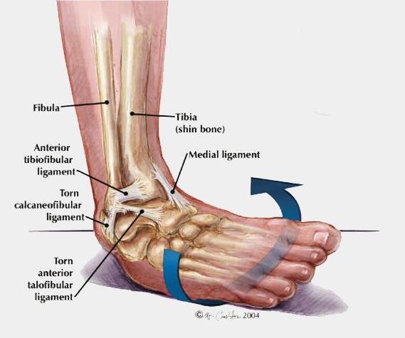 4 SIMULATION-BASED DESIGN TO PREVENT ANKLE INJURIES 4.1 INTRODUCTION Ankle sprains are one of the most common injuries among people, especially athletes.