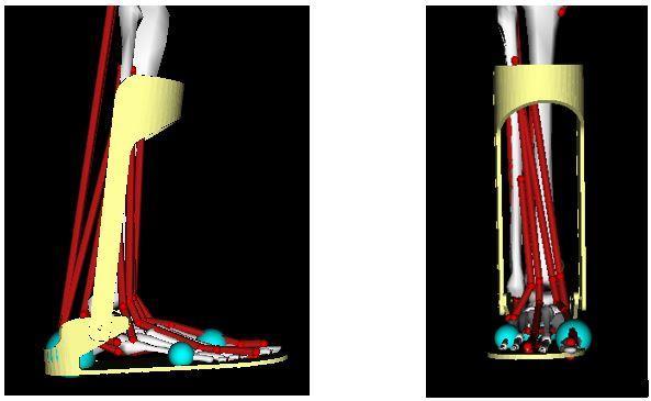 Since the subtalar angle is more than the limit, the ligaments will be damaged and will result in ankle inversion injury.