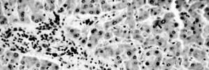 Toxic brain syndrome Granuloma in liver surrounding eggs of Schistosoma mansoni Lateral spine Schistosome egg in