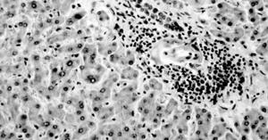 Note intense granuloma Granuloma surrounding an egg of Schistosoma mansoni in liver tissue Egg Pipe stem fibrosis