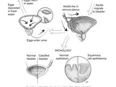 mansoni Calcified egg indicates chronic Infection.