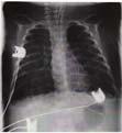 in severe airway obstruction in RSV-Bronchiolitis Berner M 2 Intensive Care Med 28 DOI 1.