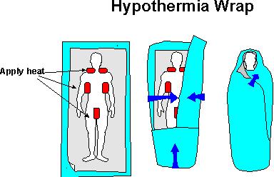 Treating Hypothermia Severe Heat can be applied to transfer heat to major arteries -at the neck for the carotid, at the armpits for the brachial, at the groin for