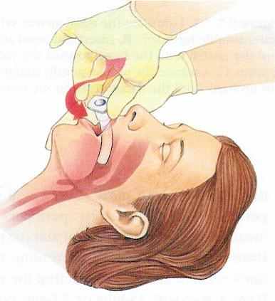 end along roof of mouth Advance airway