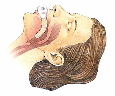 airway ½turn Flange should rest on lips