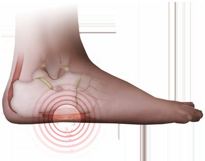 Plantar fasciitis: identify & overcome The plantar fascia is a band of connective tissue (rather like a ligament) which runs from the heel, along the bottom of the foot to the base of each of the