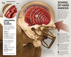 Page 1 of 5 Kids and Concussions: The effects of head injuries in young athletes By Matthew Stanmyre/The Star-Ledger January 04, 2010, 6:00AM In the first of a 3-part series on concussions and their