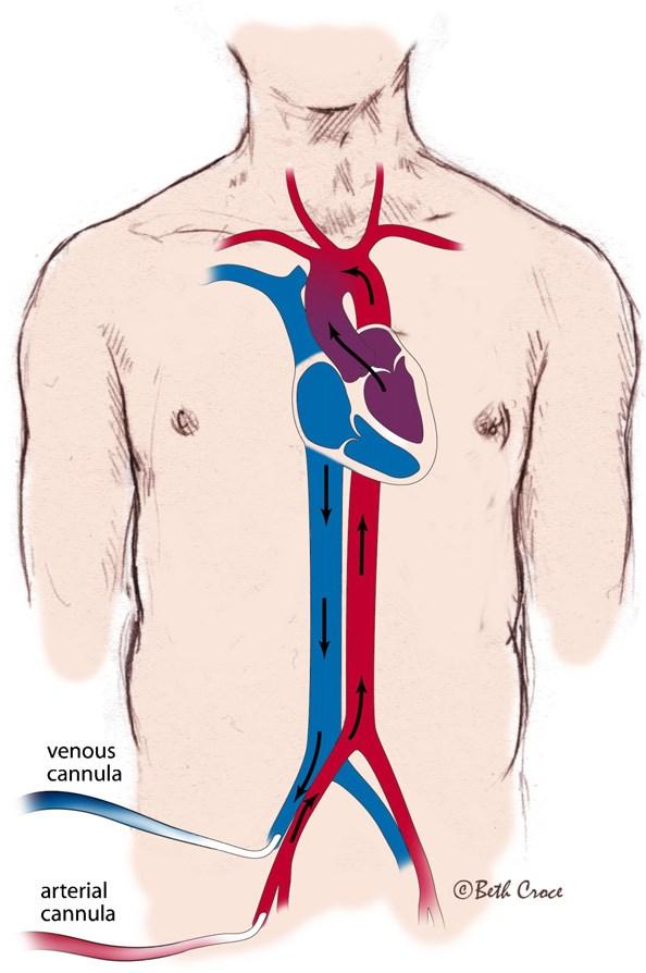 Veno-Venous (VV) configuration Provides oxygenation Blood being drained from venous system and returned to venous system.
