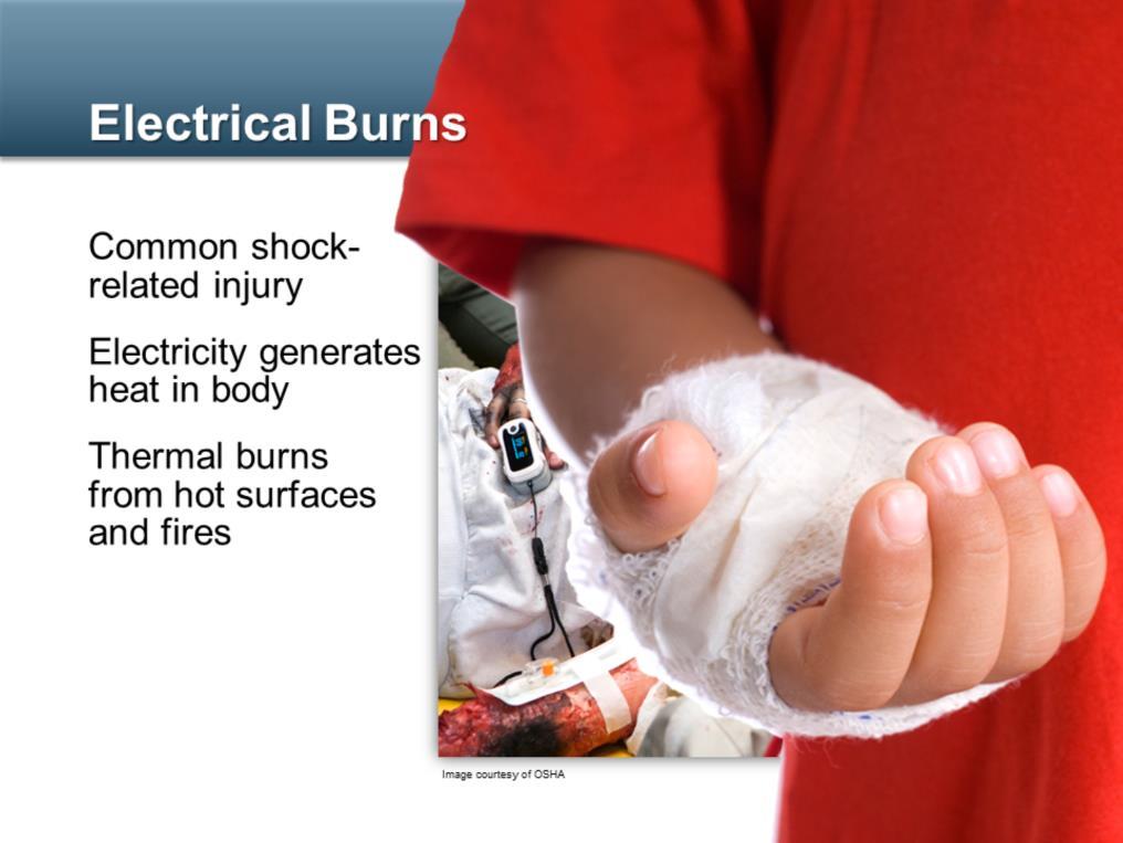 Electrical burns are a very common and serious injury related to electrical shock. Electricity in the body generates heat because the body produces resistance.