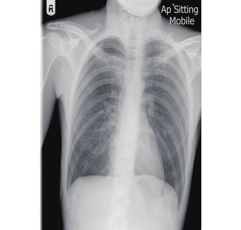 emphysema or patient is felling unwell Reconnect to DDS*** Figure 3 An example of a pneumothorax patient managed initially with a traditional chest drain.