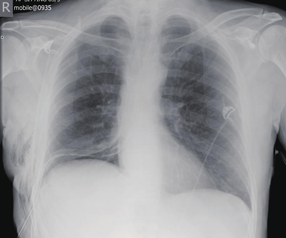Journal of Thoracic Disease, Vol 8, Suppl 1 February 2016 A S61 B C Figure 5 (A) Post lobectomy CXR with ICD in situ connected to DDS; (B) the drain was removed based on absence of air leak and