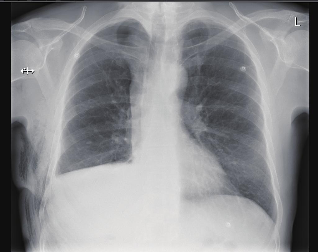 DDS, digital drain system; ICD, intercostal drain; CXR, chest X-rays. classed as an air leak or is not clinically significant to keep a tube in the chest and a patient in Hospital?