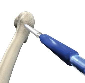 Step 9 ASPIRATE CORE (RECOMMENDED) Once debridement is complete, use the suction tip from the PRO-DENSE Core