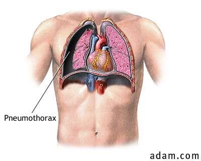 Pneumothorax http://www.pennhealth.