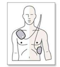 Introduction to AED Chest Preparation and Electrodes Pad Placement: 1. Expose the person's chest. 2. (H) If the person has a lot of chest hair, you may have to shave it. 3.