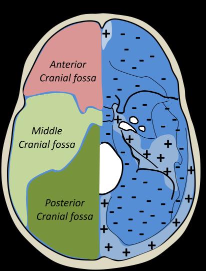 butterfly shaped middle cranial fossa is enclosed anteriorly by the lesser wing and the anterior part of the greater wing of the sphenoid, and laterally and inferiorly by the greater wing of the