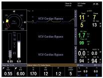Ventilation modes upgrade VCV cardiac bypass mode in mechanical ventilation A cardiac bypass mode with VCV has been added.
