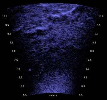 Imaging sonar was utilized in this area in an attempt to visualize the area of deficiency.