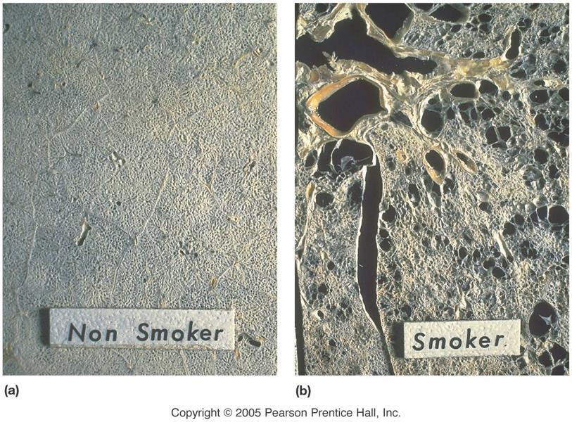 Emphysema Besides cancer, smoking can also lead to emphysema. Alveoli become dry and brittle, and eventually rupture.